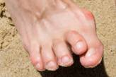 Bunion pain Houston